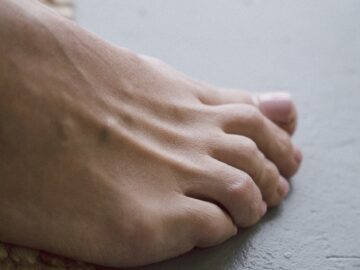 mycose-ongle-pied